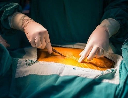 انواع جراحی های لاغری چیست و کدام یک بهتر است؟