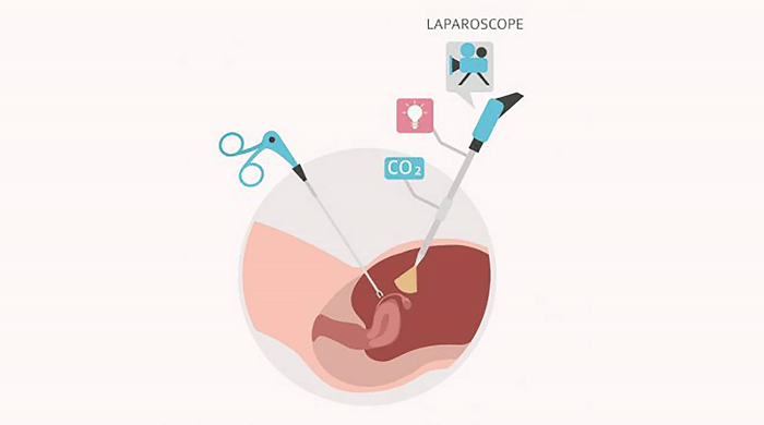 جراحی لاپاراسکوپی برای درمان انواع بیماری ها