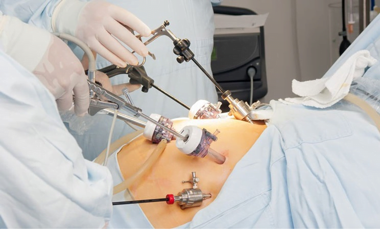 لاپاراسکوپی برای جراحی های لاغری